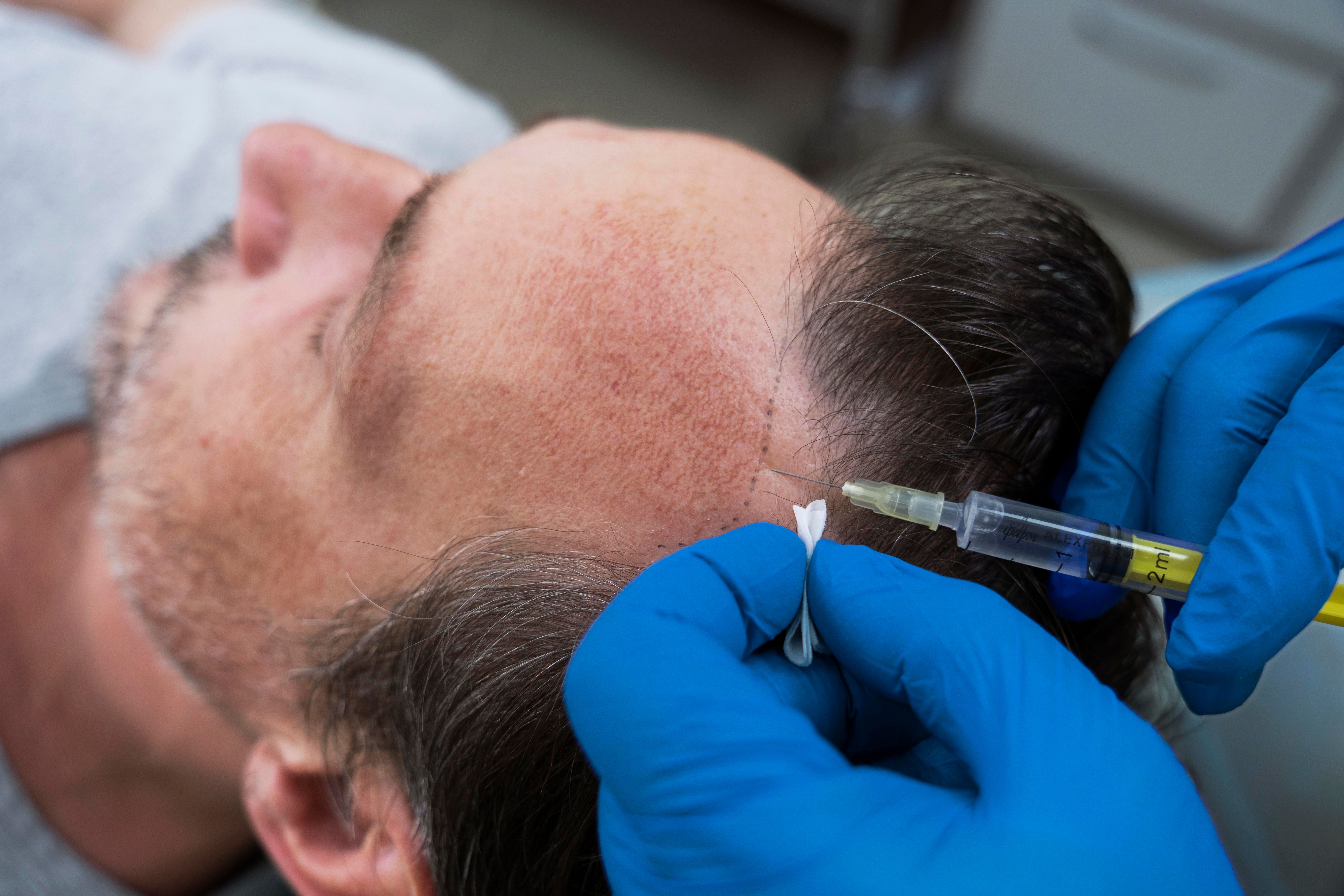 PRP Therapy